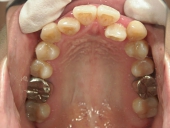 矯正歯科　治療前　上顎