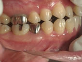 矯正歯科　治療前　右