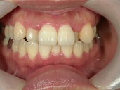 矯正歯科　治療前　正面