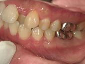 矯正歯科　治療前　左