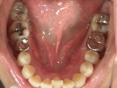 矯正歯科　治療前　下顎