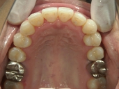 矯正歯科　治療後　上顎