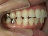 矯正歯科　治療後　右