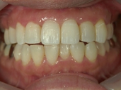 矯正歯科　治療後　正面