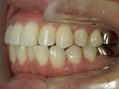 矯正歯科　治療後　左
