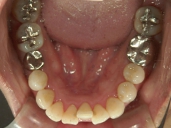 矯正歯科　治療後　下顎