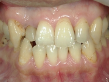 矯正歯科　治療前