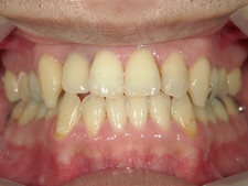 矯正歯科　アクアシステム（透明マウスピース矯正）　治療後