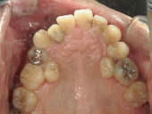 矯正歯科　治療前　上顎