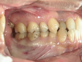 矯正歯科　治療前　右