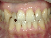 矯正歯科　治療前　正面