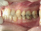 矯正歯科　治療前　左
