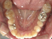 矯正歯科　治療前　下顎