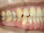 矯正歯科　治療後　右