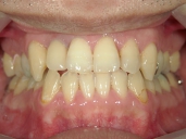 矯正歯科　治療後　正面