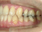 矯正歯科　治療後　左
