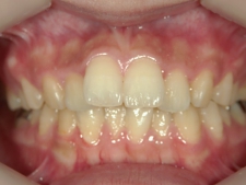 矯正歯科　治療前