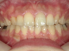 矯正歯科　アクアシステム（透明マウスピース矯正）　治療後