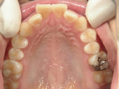 矯正歯科　治療前　上顎