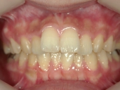 矯正歯科　治療前　正面