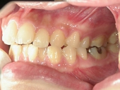 矯正歯科　治療前　左