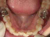 矯正歯科　治療前　下顎