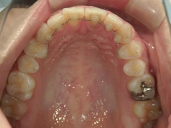 矯正歯科　治療後　上顎