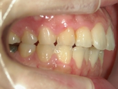 矯正歯科　治療後　右
