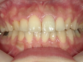 矯正歯科　治療後　正面