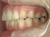 矯正歯科　治療後　左