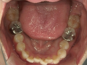 矯正歯科　治療後　下顎