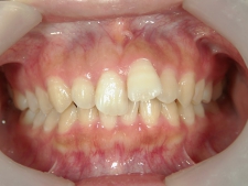 矯正歯科　治療前