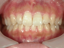 矯正歯科　アクアシステム（透明マウスピース矯正）　治療後