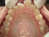 矯正歯科　治療前　上顎