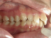矯正歯科　治療前　右