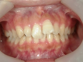 矯正歯科　治療前　正面