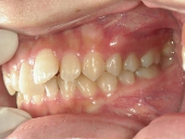 矯正歯科　治療前　左