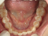 矯正歯科　治療前　下顎