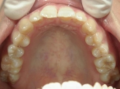 矯正歯科　治療後　上顎