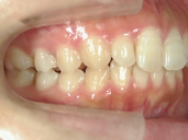 矯正歯科　治療後　右