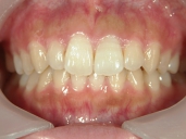 矯正歯科　治療後　正面
