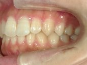矯正歯科　治療後　左