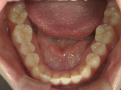 矯正歯科　治療後　下顎