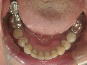 矯正歯科　治療後　下顎