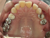 矯正歯科　治療前　上顎