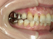 矯正歯科　治療前　右