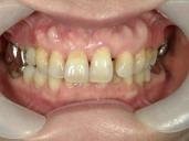 矯正歯科　治療前　正面