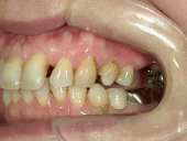 矯正歯科　治療前　左