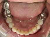 矯正歯科　治療前　下顎