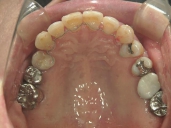 矯正歯科　治療後　上顎